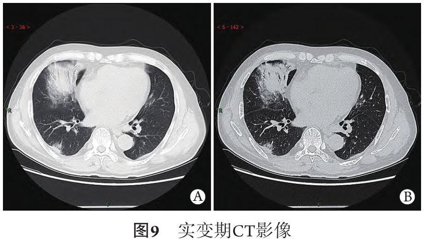 新冠肺炎的ct典型和不典型表現以及影像學分期