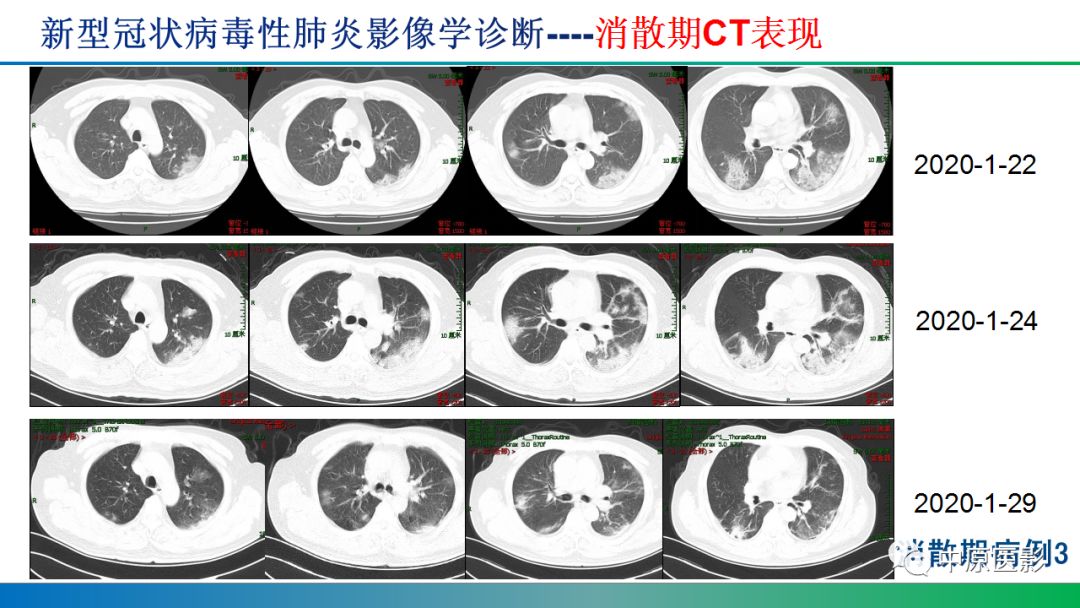 新型冠状病毒肺炎影像学诊断浅析
