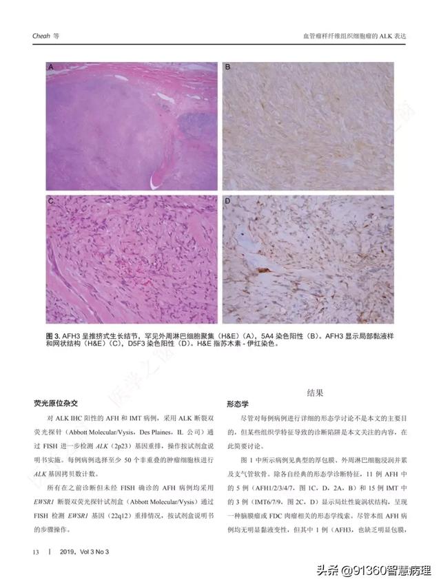 正文:关键关键词:间变性淋巴瘤激酶(alk,血管瘤样纤维组织细胞瘤(afh