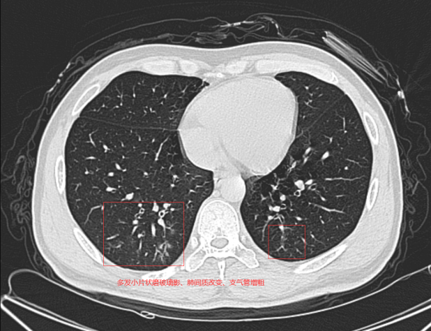 右下肺明显;右肺下叶后段伴有肺间质纤维化及胸膜粘连影像检查:ct平扫