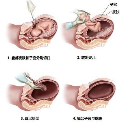 清宫手术过程图图片