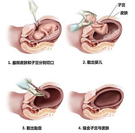 女生怎么生孩子开刀图片