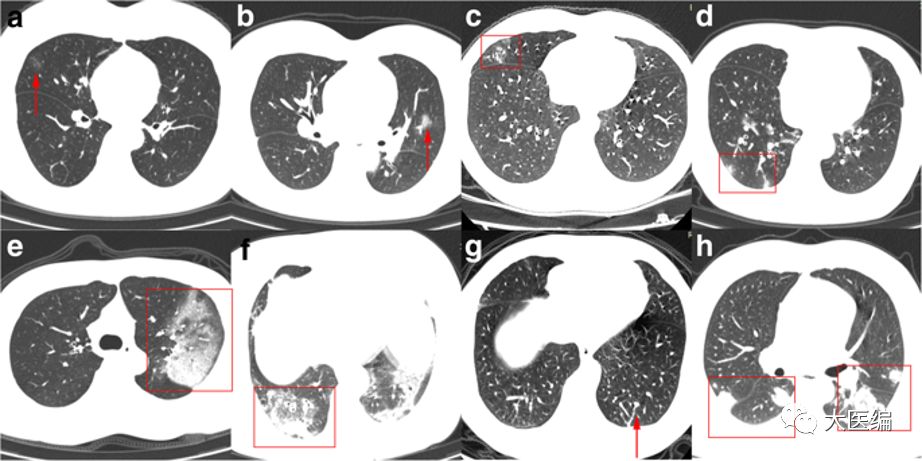 新型冠状病毒肺炎胸部ct影像学特征