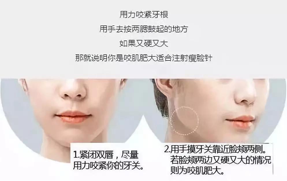 咬肌肥大医生却不建议我打瘦脸针