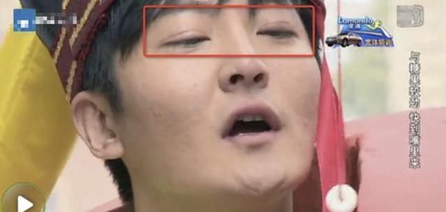 有网友猜测他的双眼皮就是割的,看照片里面的情况可能还没有修复好.