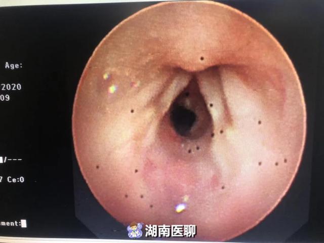 男婴嗓子眼仅剩米粒大空隙,随时可能窒息!生命之门该如何打通?