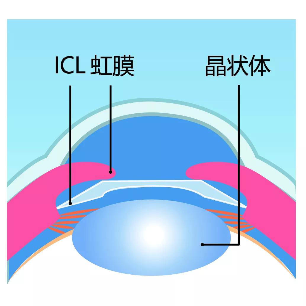 科普icl晶体植入术