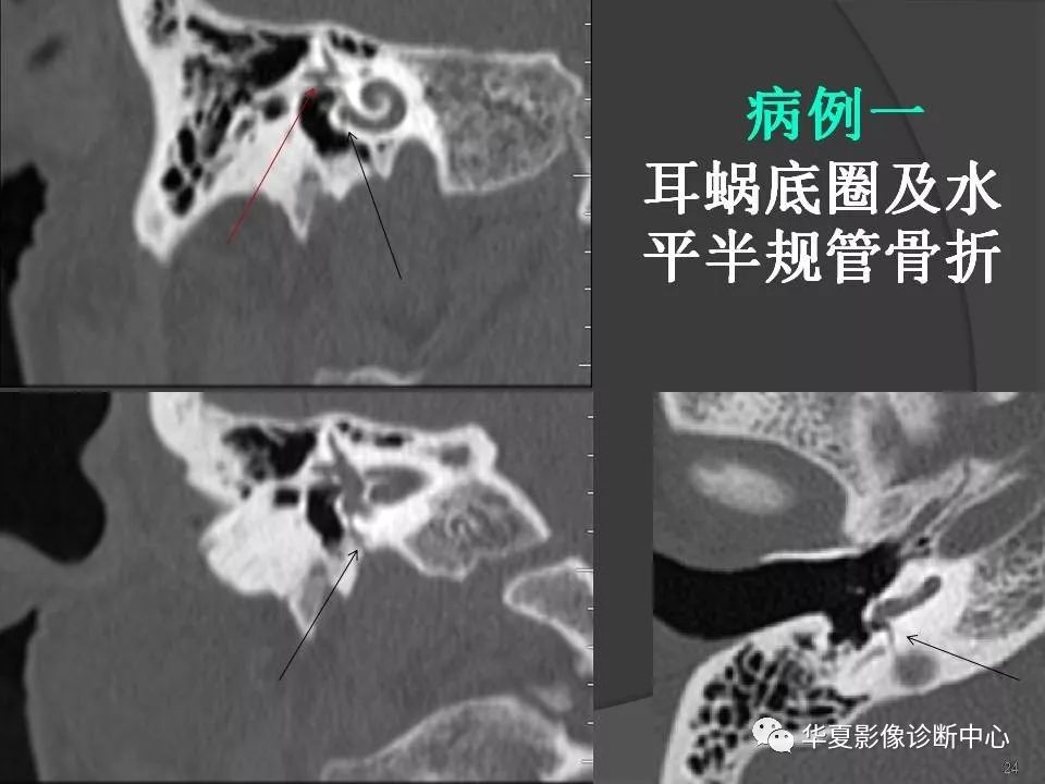 颞骨解剖及ct三维重建