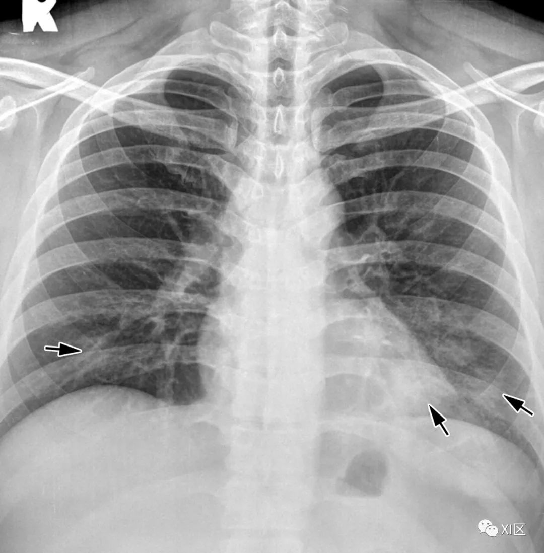 肺炎ct影像图片图片