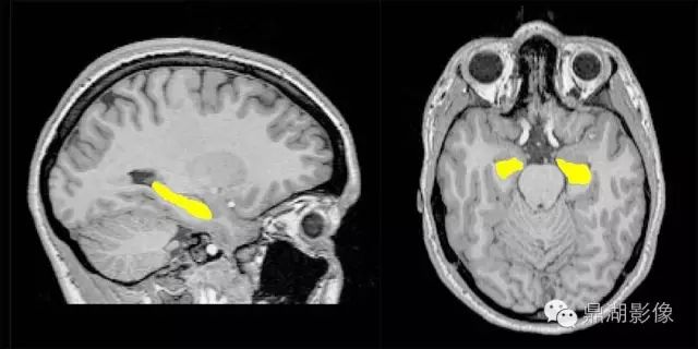 头颅磁共振海马解剖图图片