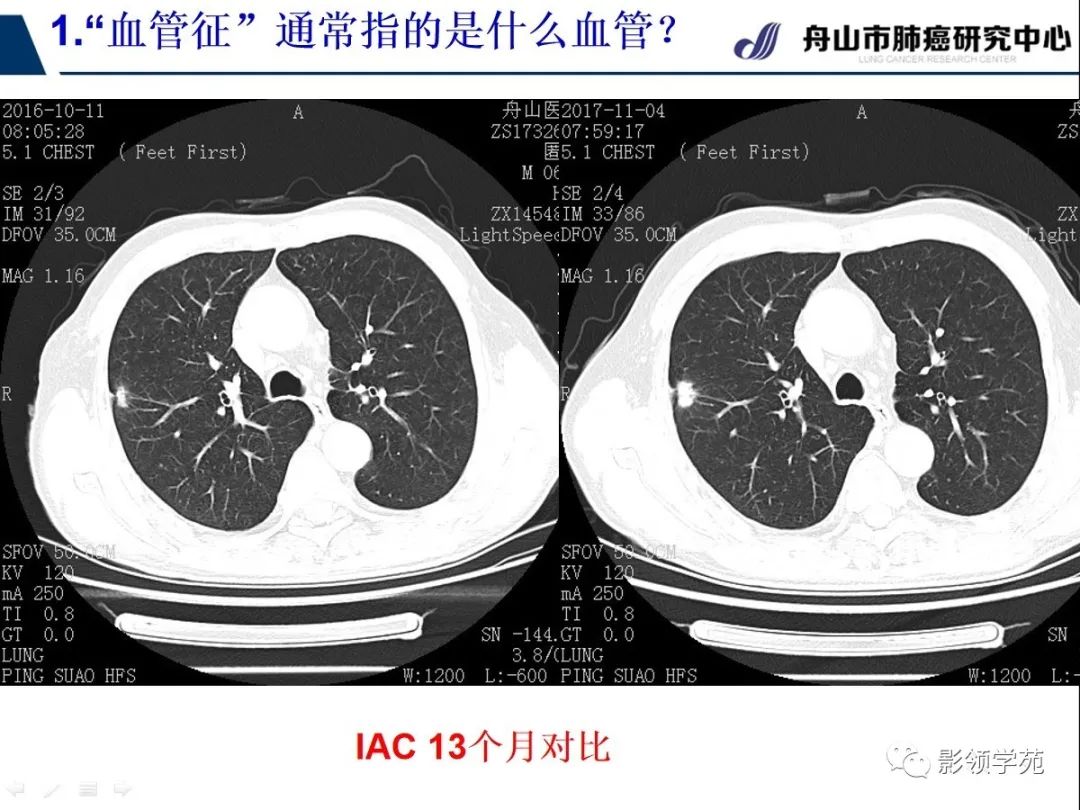 早期肺癌ct图 图解图片