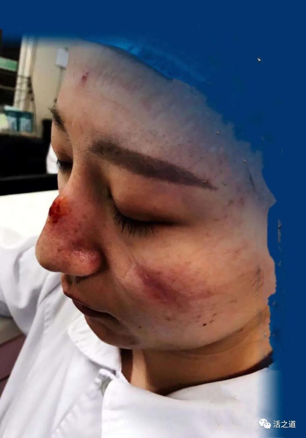 长期戴口罩皮肤痒易爆暗疮如果皮肤不适请看这里