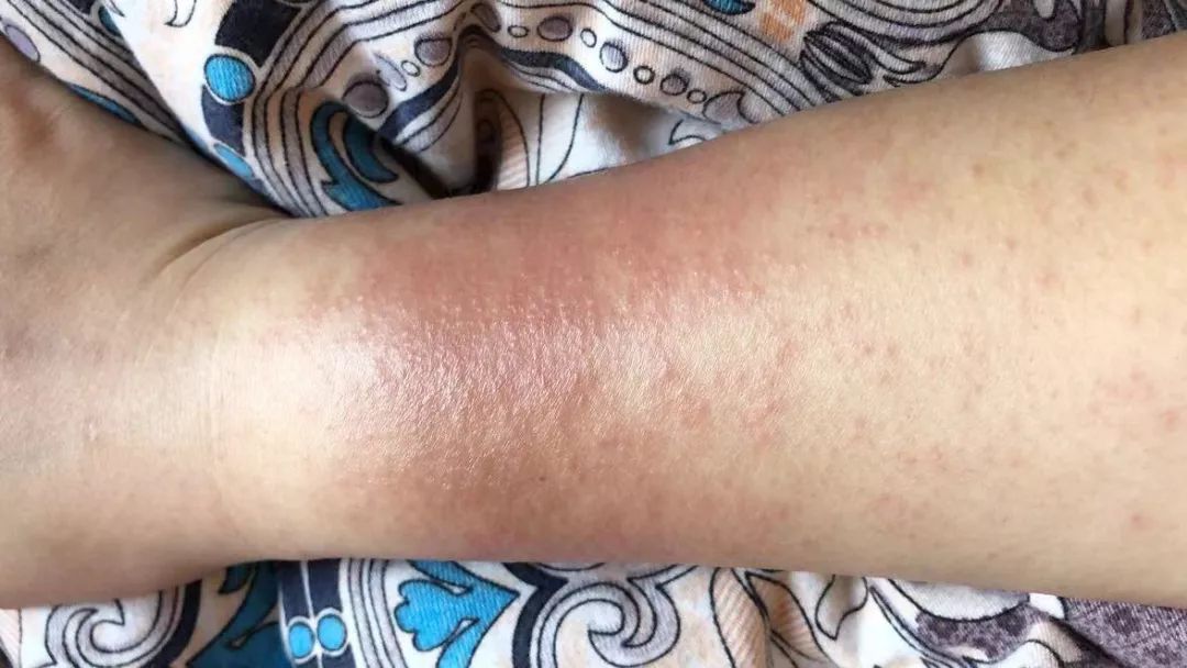 消毒引起全身过敏,但她依然坚守岗位