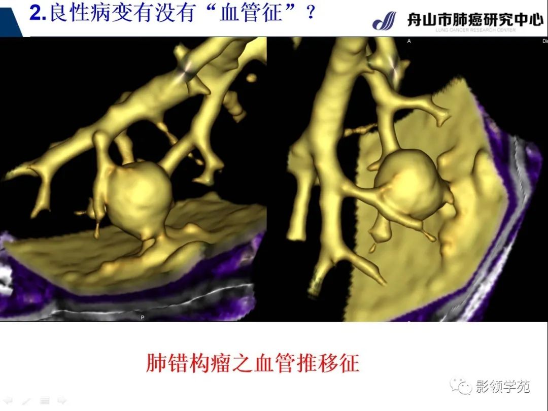 經典ct徵象對早期肺腺癌亞型分型價值探討血管徵