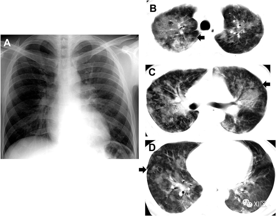 入院第11天的胸部ct图像显示双侧异常,包括小叶间隔增厚(肺尖部;b,箭)