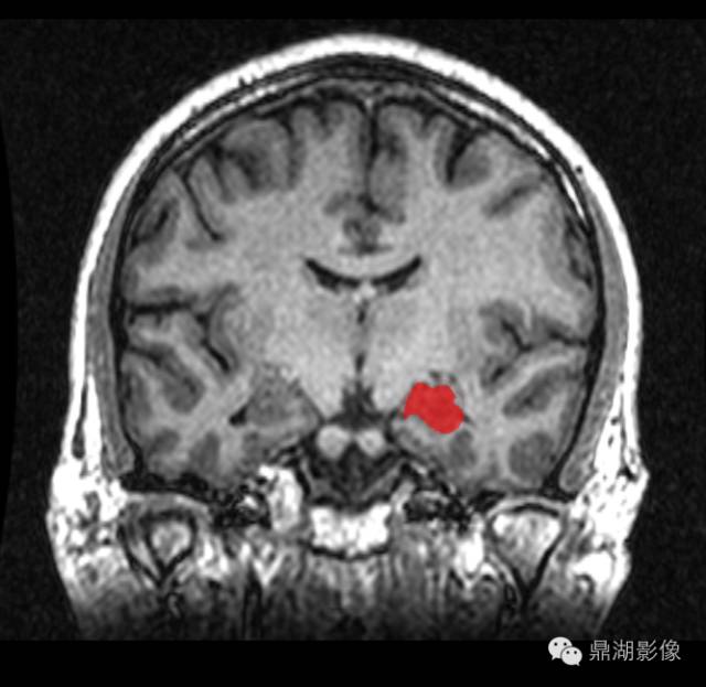 核磁海马图片