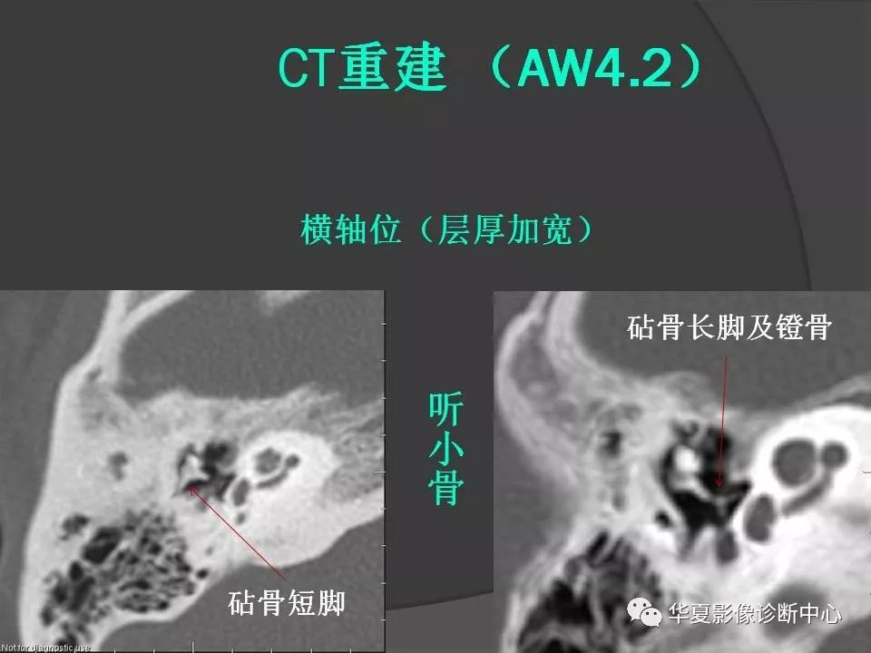 顳骨解剖及ct三維重建