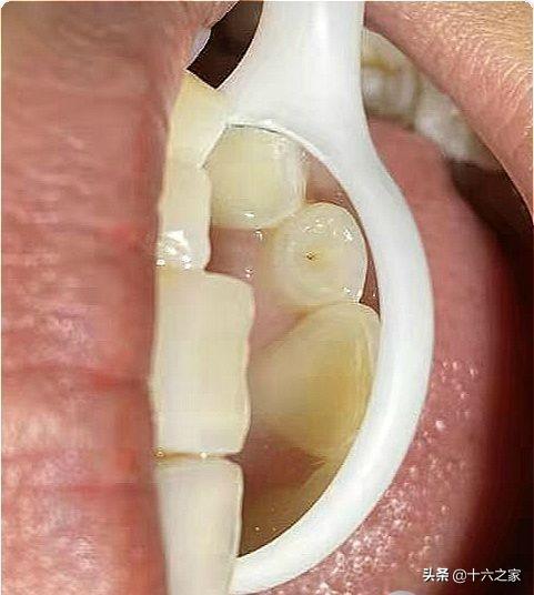 牙内陷病例