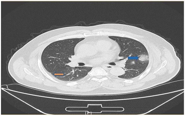 20秒确诊新冠肺炎ai医生看ct准确率达96将上岗百家医院