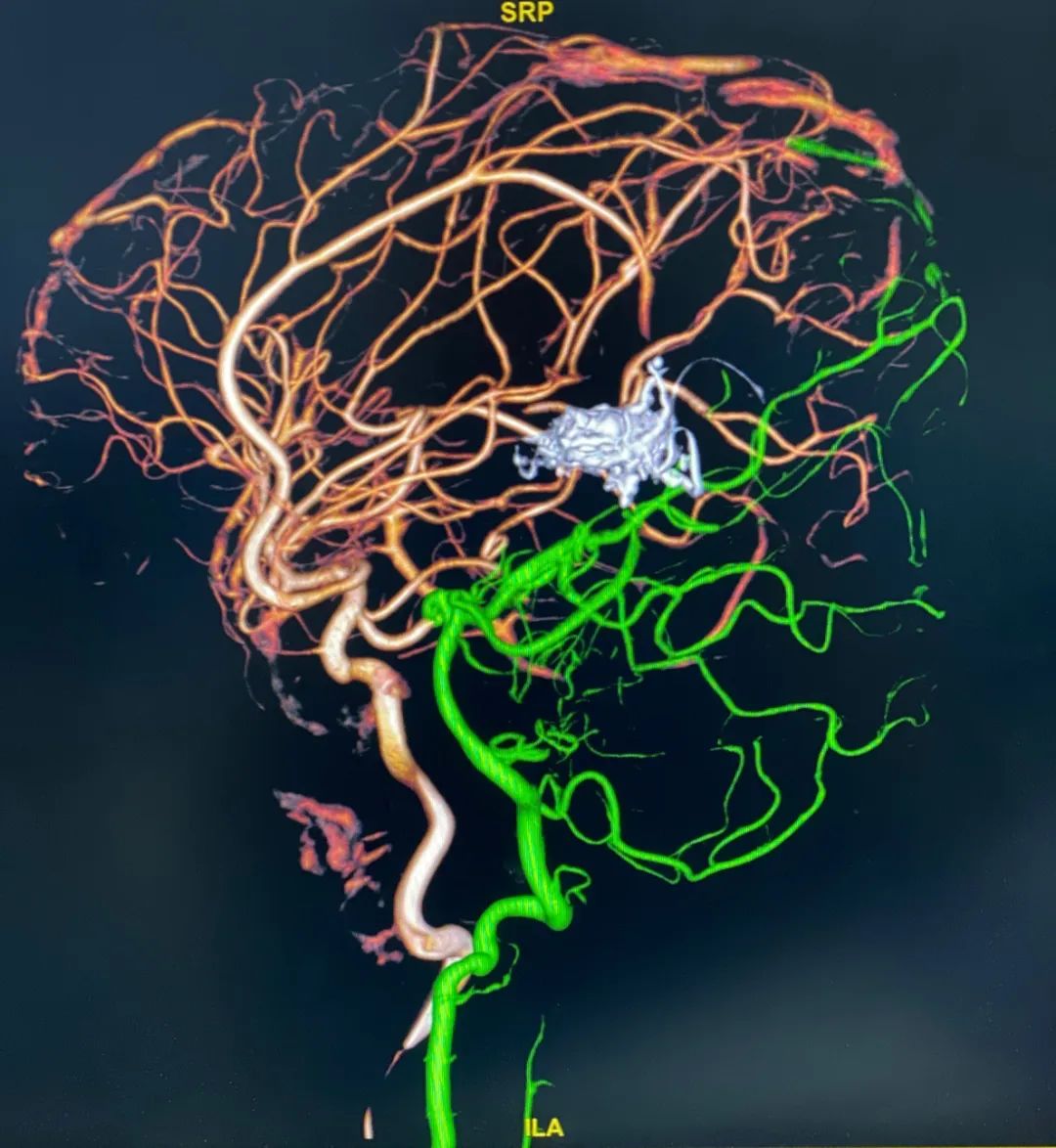 何旭英丨动静脉联合入路栓塞galen区avm