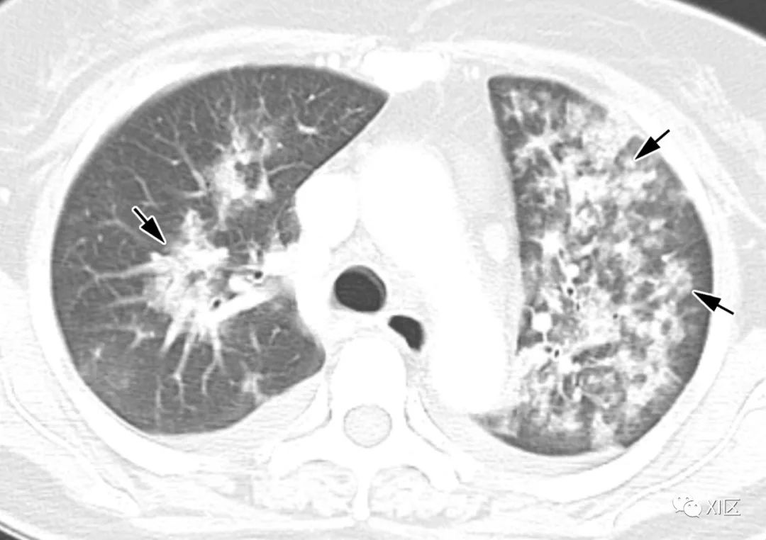 病毒性肺炎的影像学表现