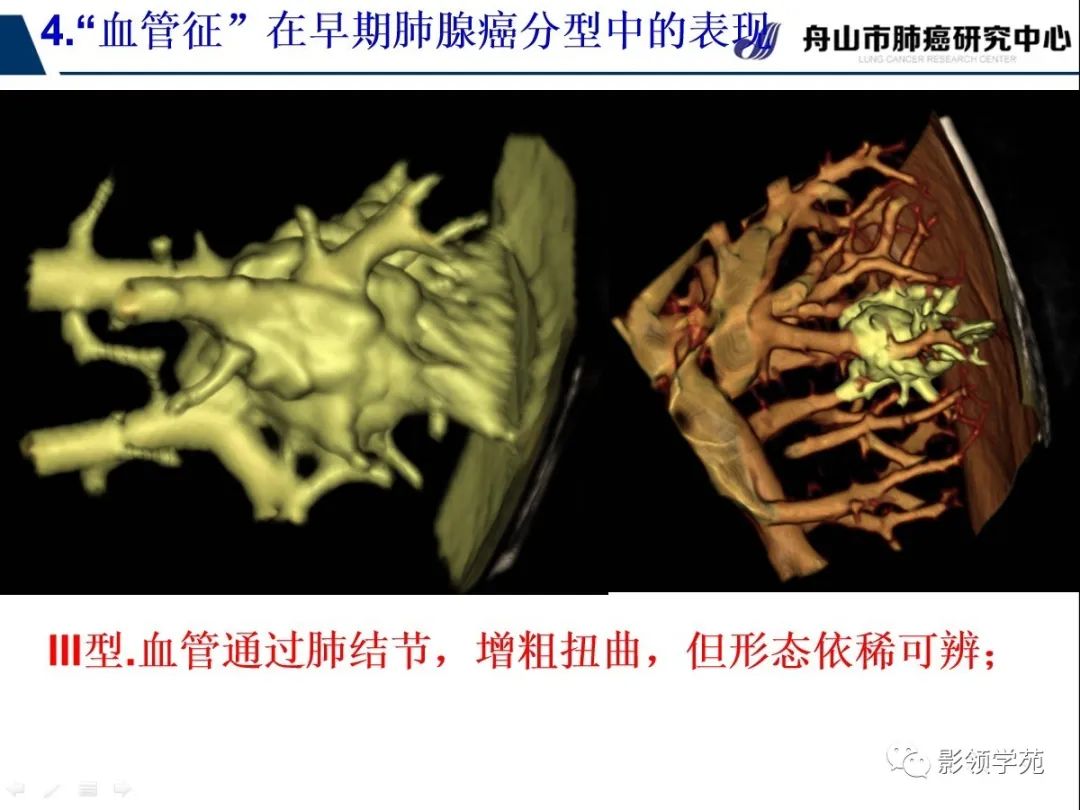 经典ct征象对早期肺腺癌亚型分型价值探讨血管征