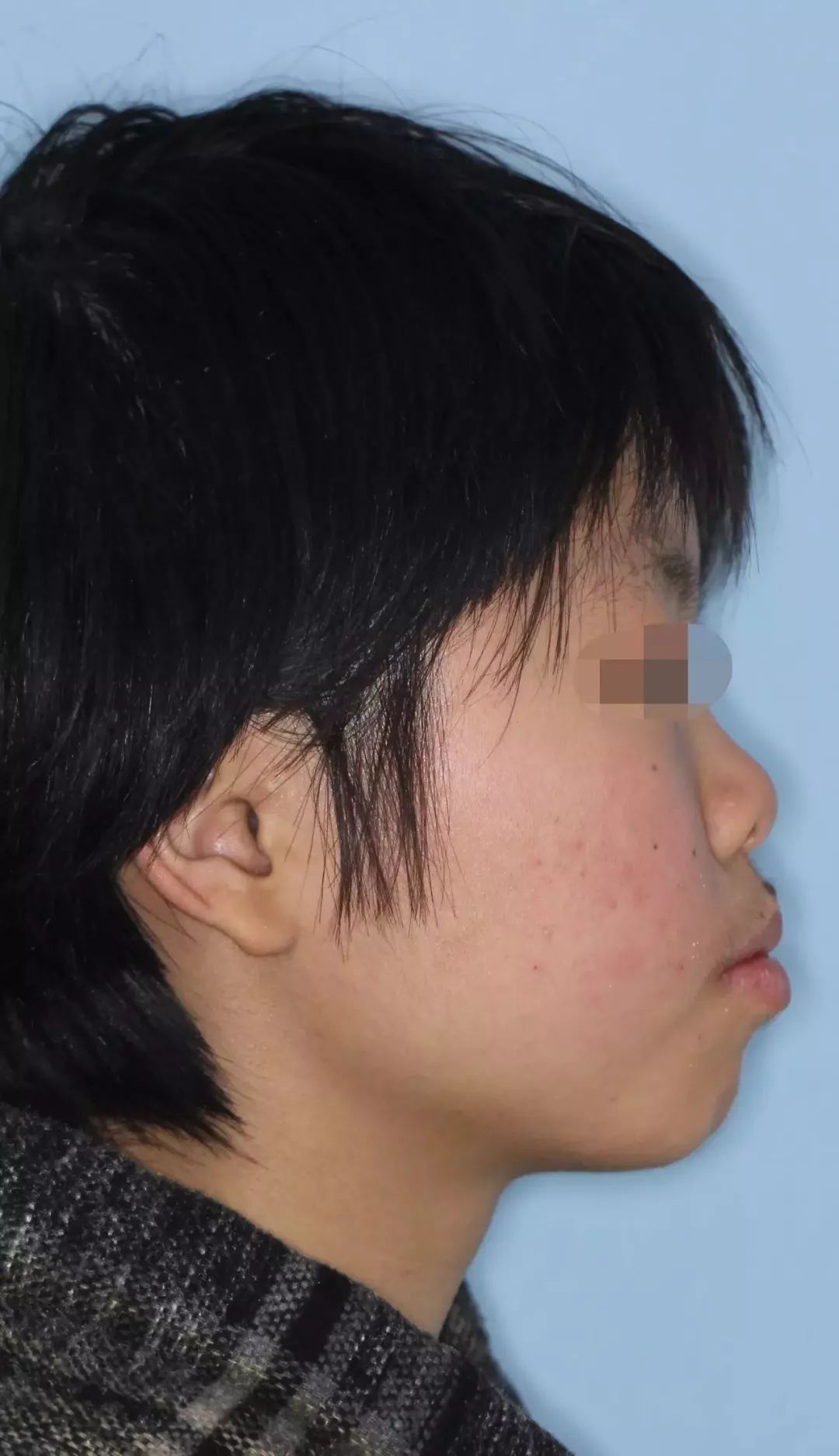 拔牙正畸那点事看完你就都明白了