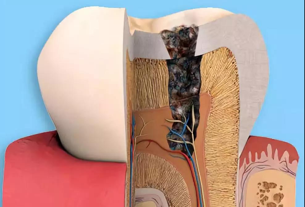 酸使牙釉质脱矿是龋齿形成的第一步.酸哪来的?