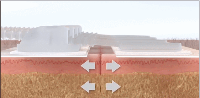 患者可自行拆除愈合周期大概是一到两周防止外扩给伤口提供轻微压力