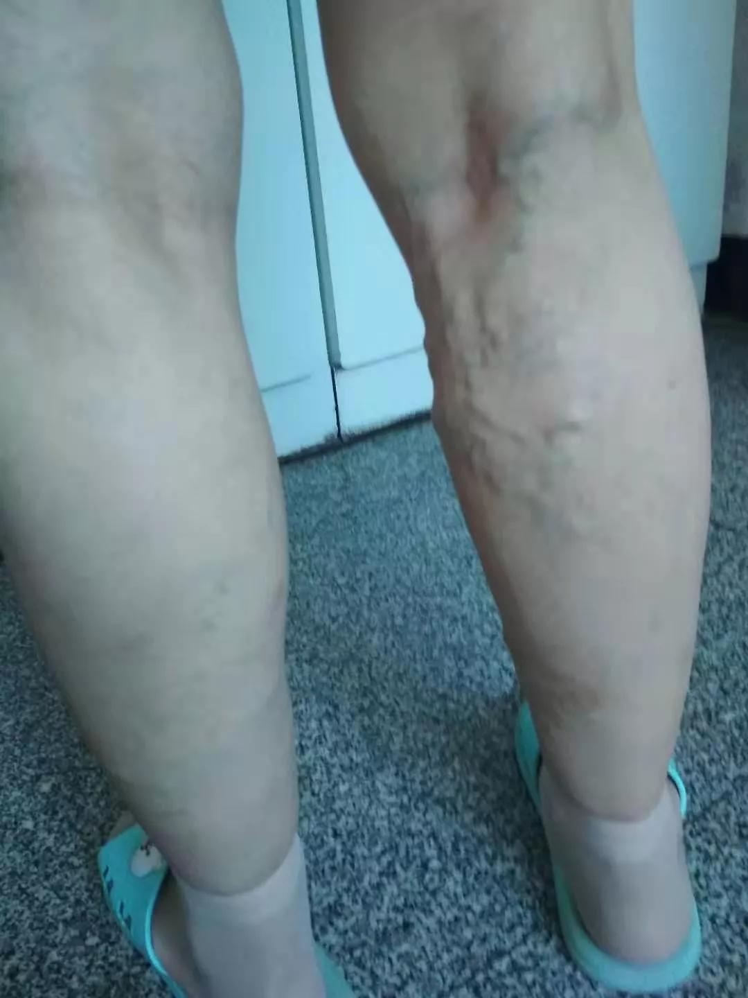 一位45岁患者留言:腿部布满蚯蚓般的血管