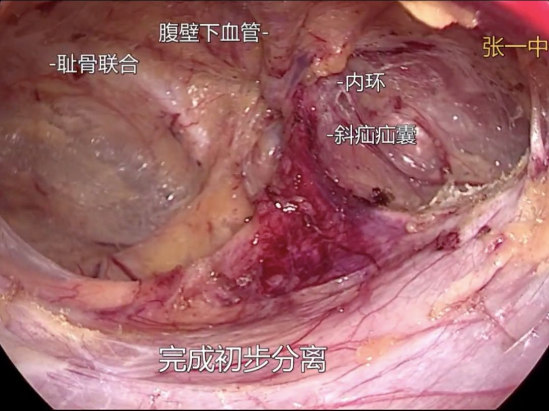 单孔tep 如何操作?看这个视频就够了_手术