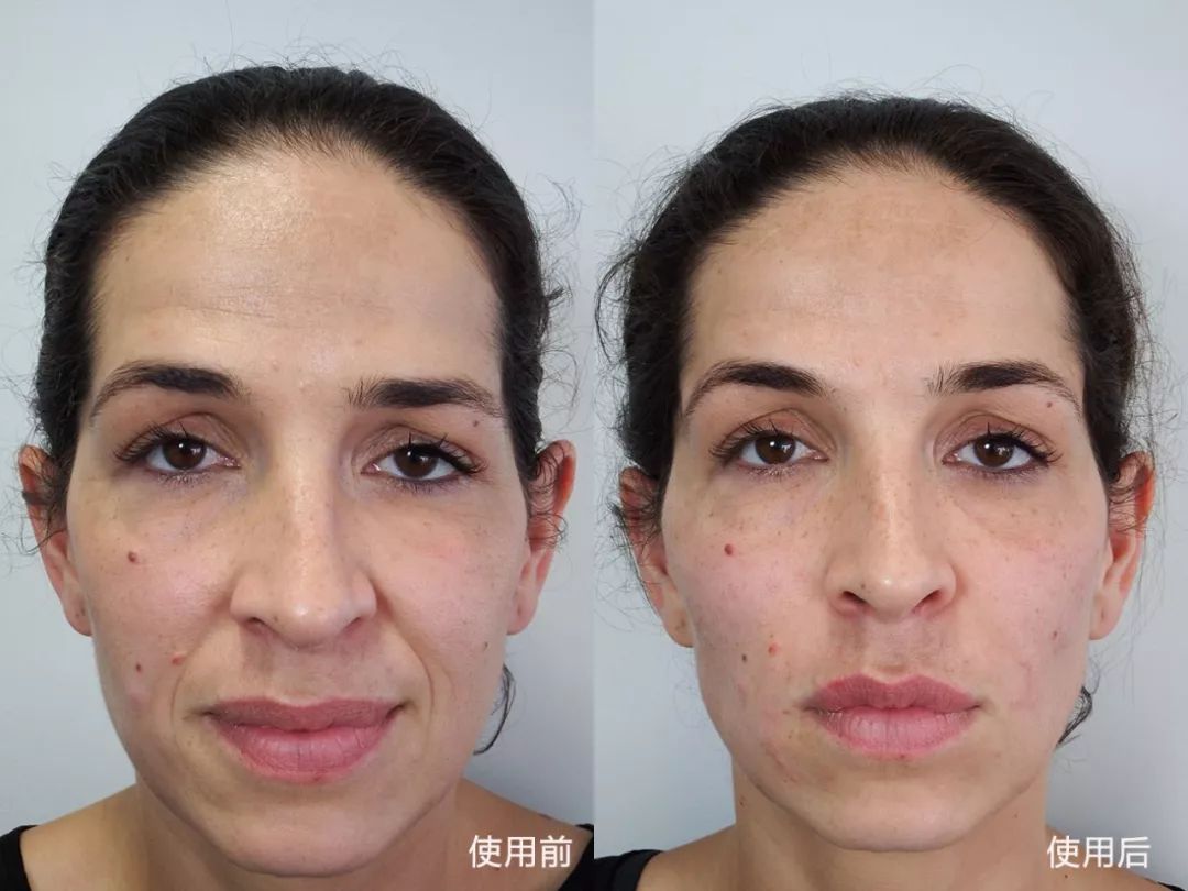 女人最怕三八纹教你一招不打针不手术7天赶走衰老法令纹安全还省钱