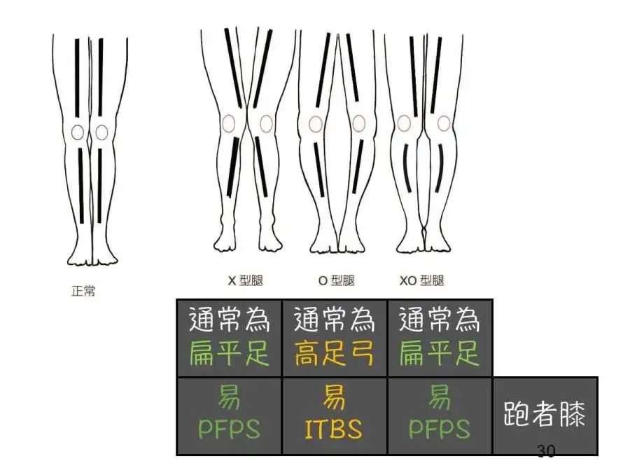 你的全身痠痛竟然是高弓足引起的