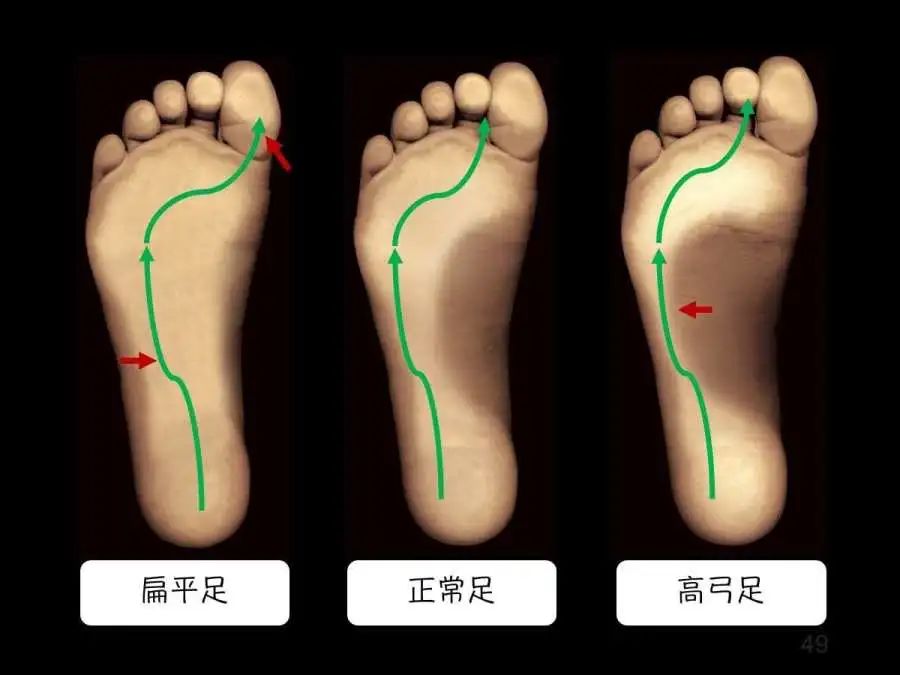 高弓足和正常足照片图片