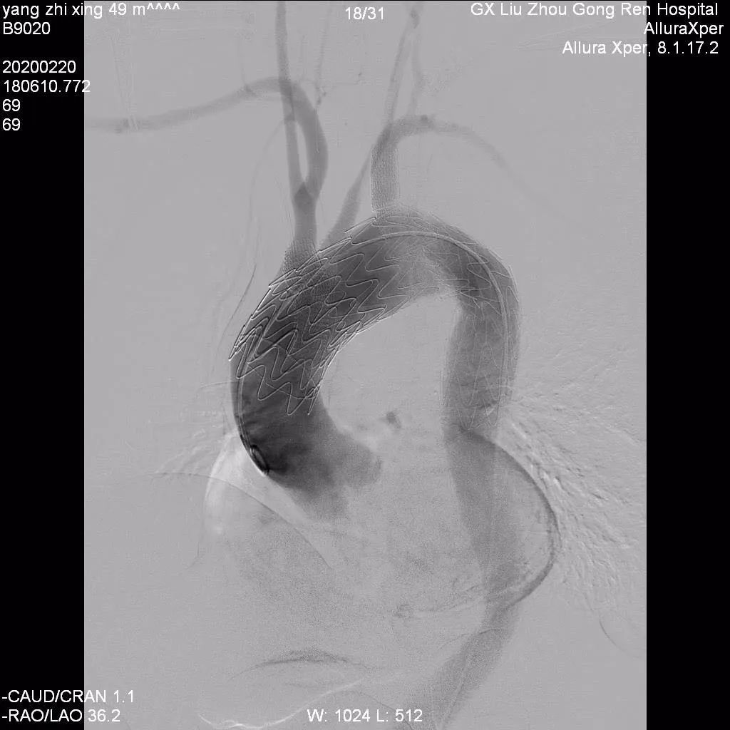 主动脉弓钙化x线图片图片