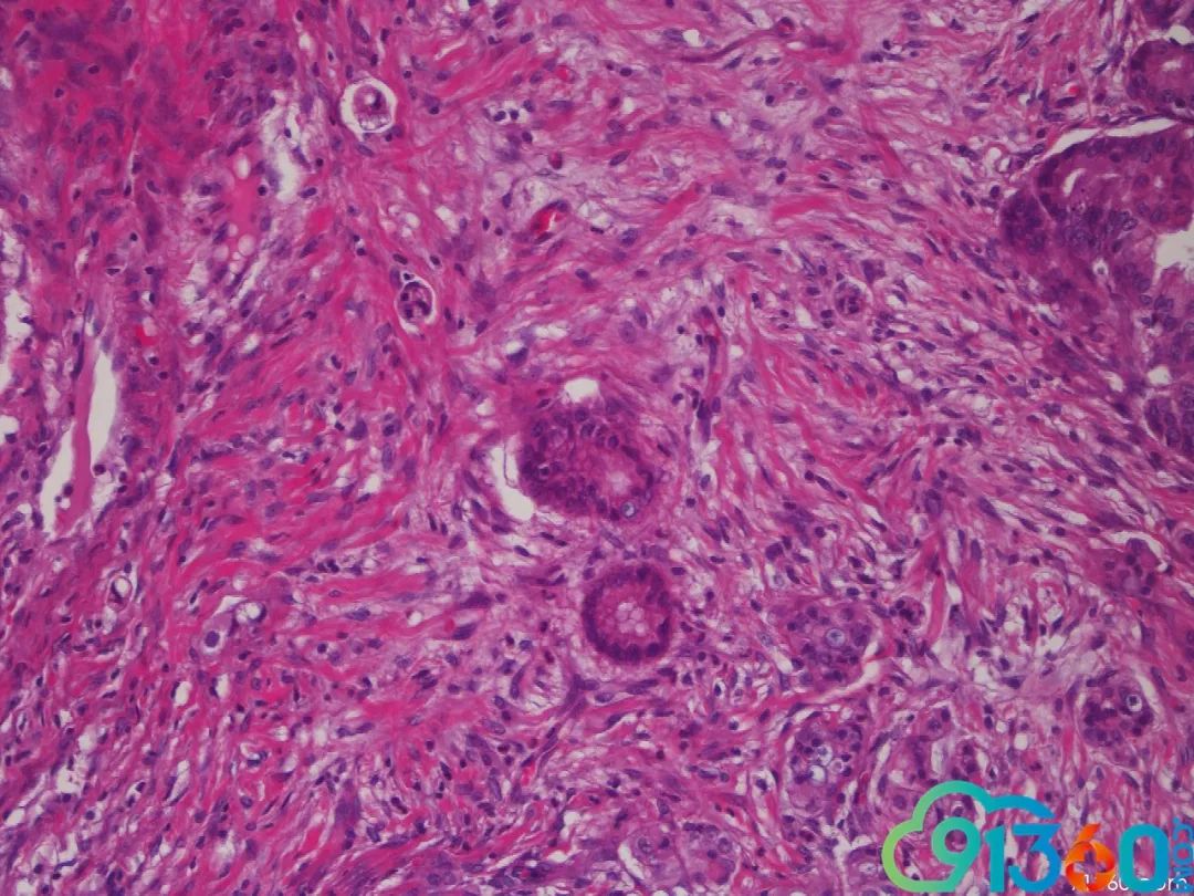 叶郁红粘液性肿瘤常常碰到,常常纠结.