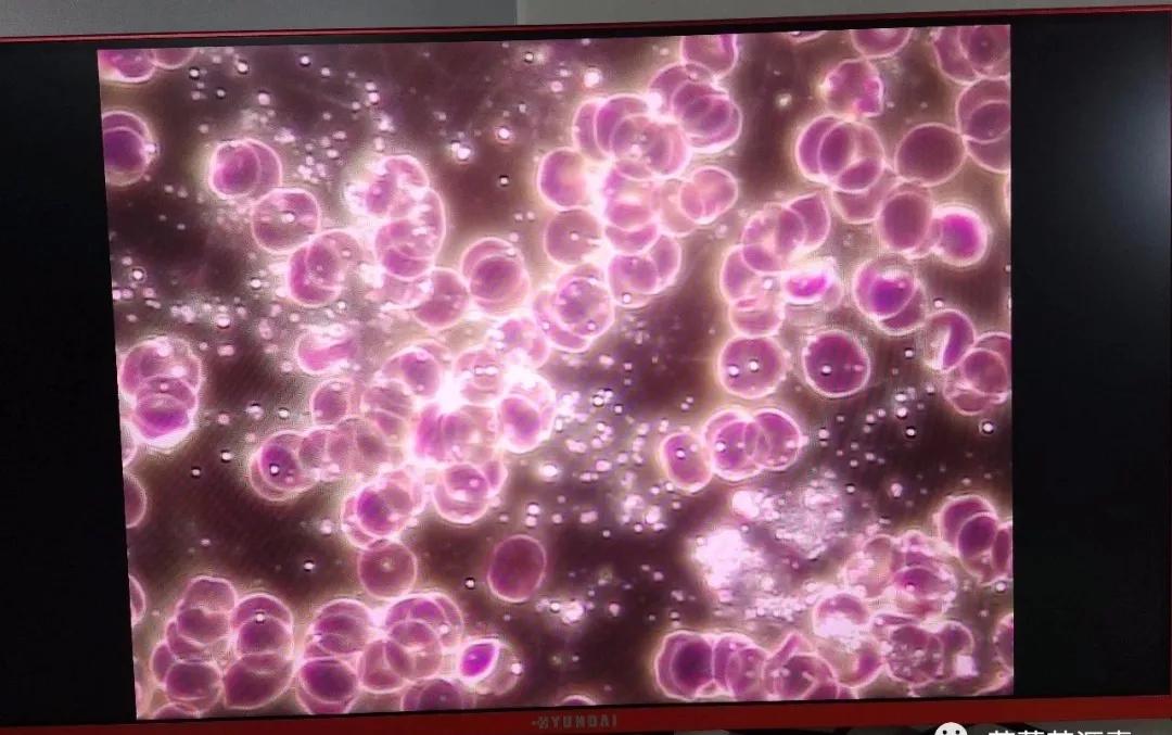 血液中糖偏高另一个类似后勤保障功能的,就是血红细胞;若红细胞聚集在