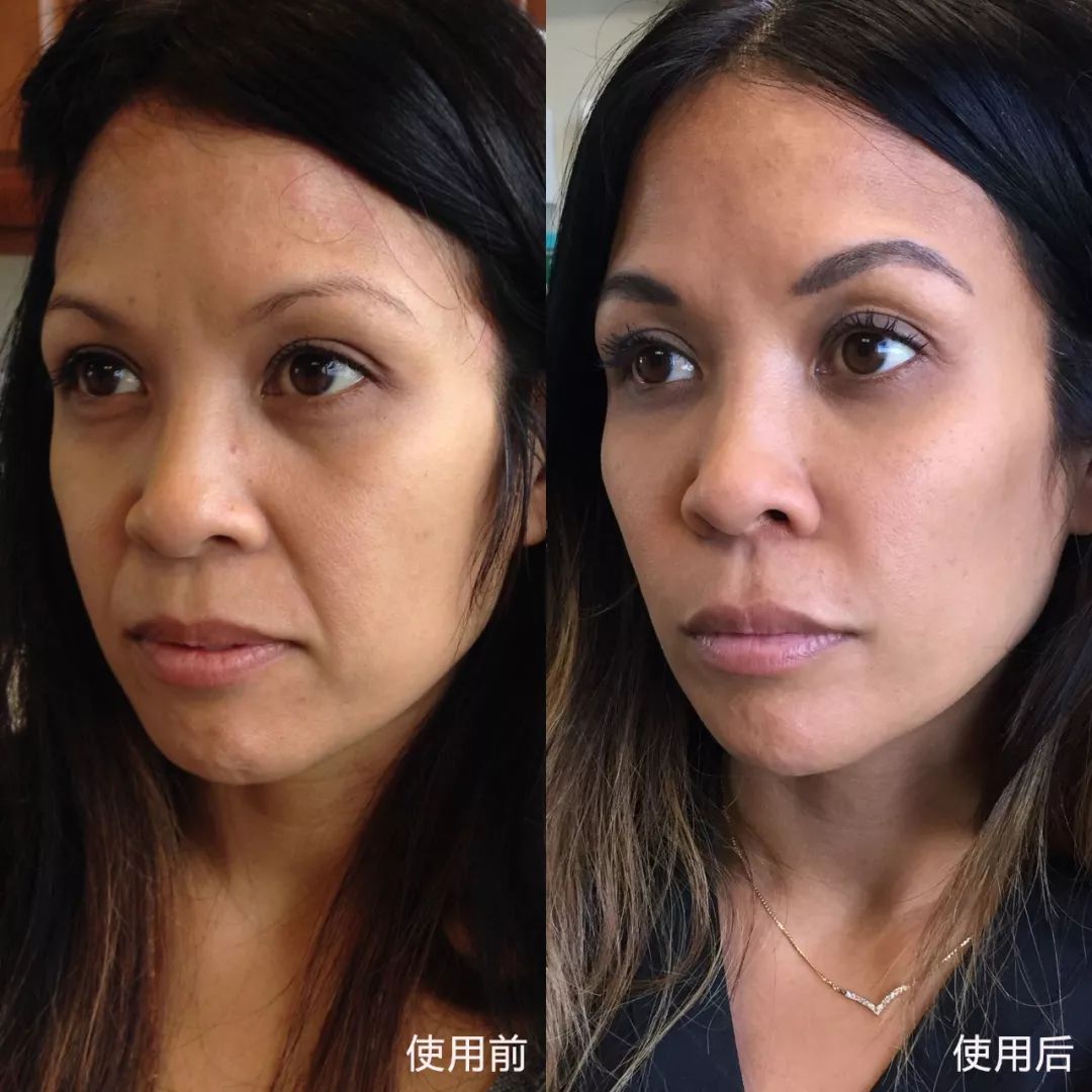 达到即时修复,填充法令纹的效果