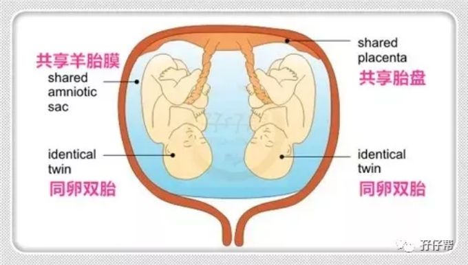 单绒单羊毛膜双胞胎:老妹,你踩我脐带了_双羊