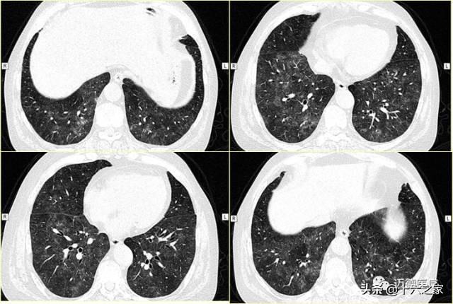 从基础到临床详解肺间质病变基本ct表现