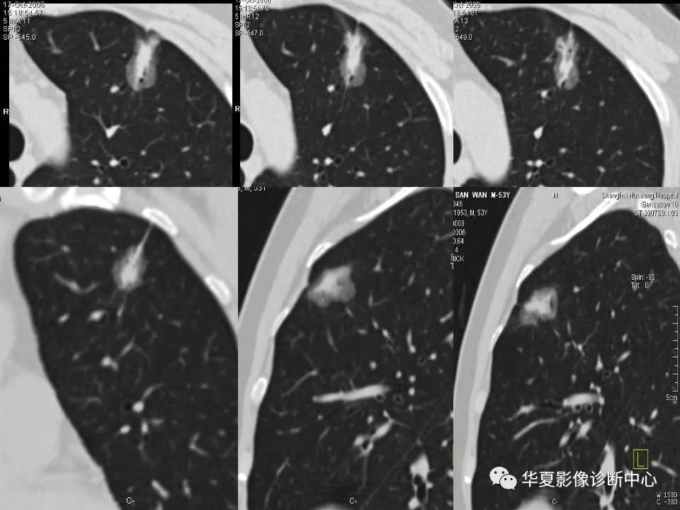 肺磨玻璃結節的ct診斷