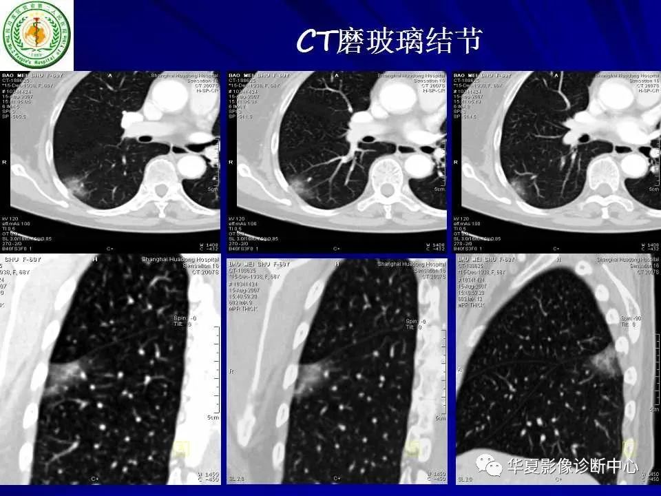 肺磨玻璃結節的ct診斷