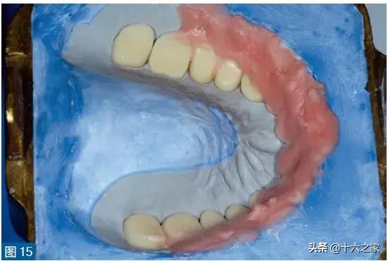 个性化自然的全口义齿