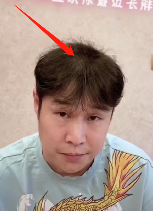 小沈阳头顶发亮有秃顶迹象妻子感慨多么痛的领悟