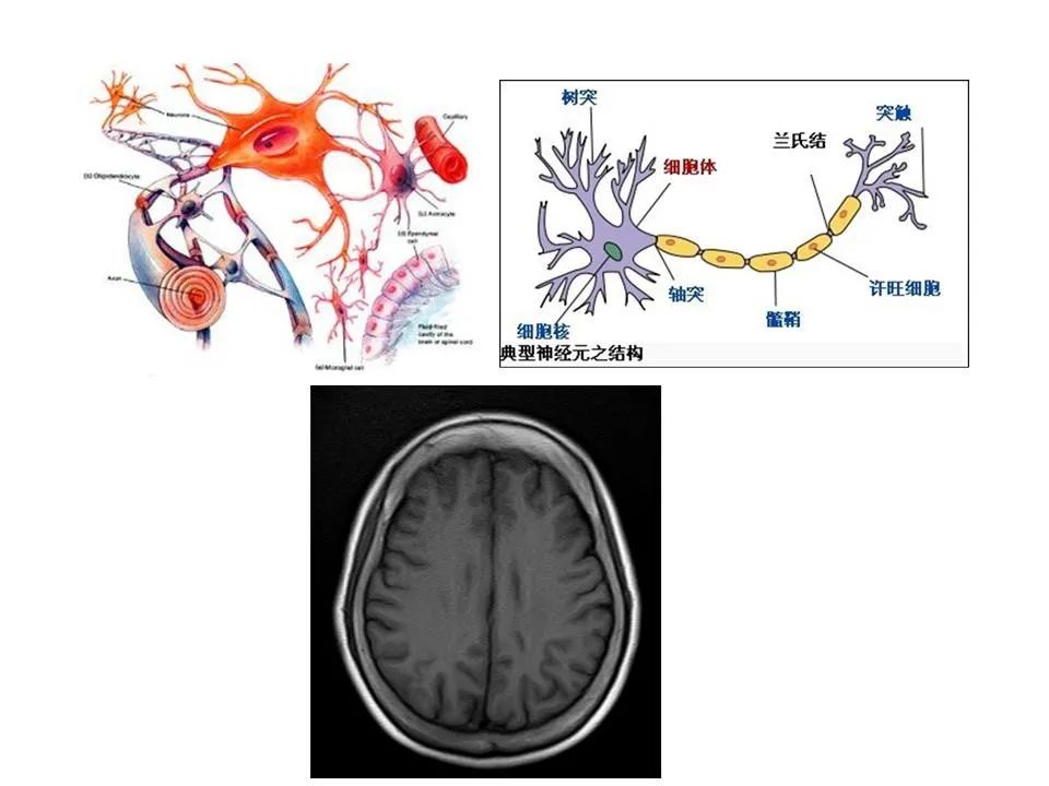 脑脱髓鞘疾病的影像诊断