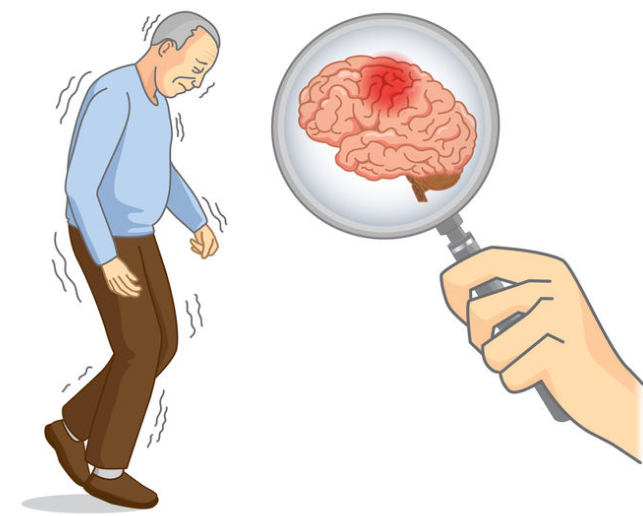 原创中年后脑梗易高发这6个坏习惯会加速脑梗到来赶紧改掉