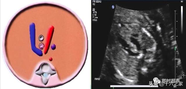 胎儿动脉导管切面图片图片