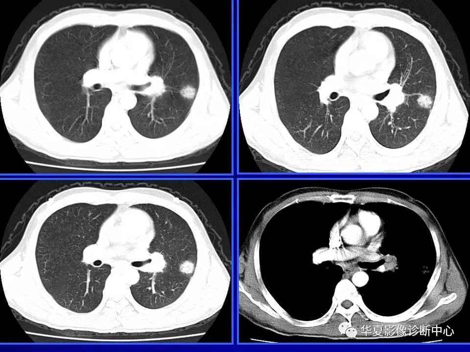 肺磨玻璃结节的ct诊断