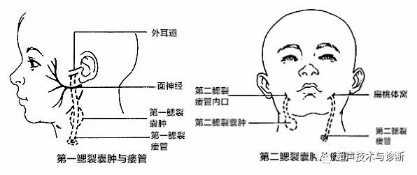 浅表超声鳃裂畸形鳃裂囊肿鳃裂瘘的超声诊断