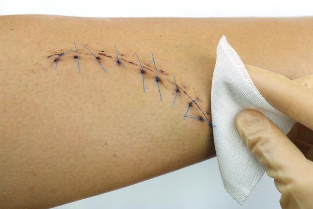 大夫,医学那么发达了,我的伤口怎么还是针线缝的?疤多大啊